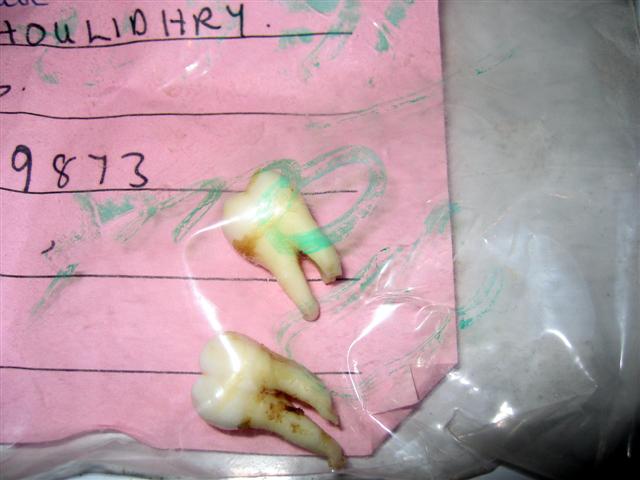 extremely old teeth